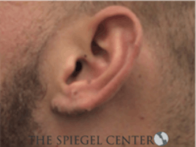 Ear Lobe Repair Before & After Gallery - Patient 819105 - Image 2