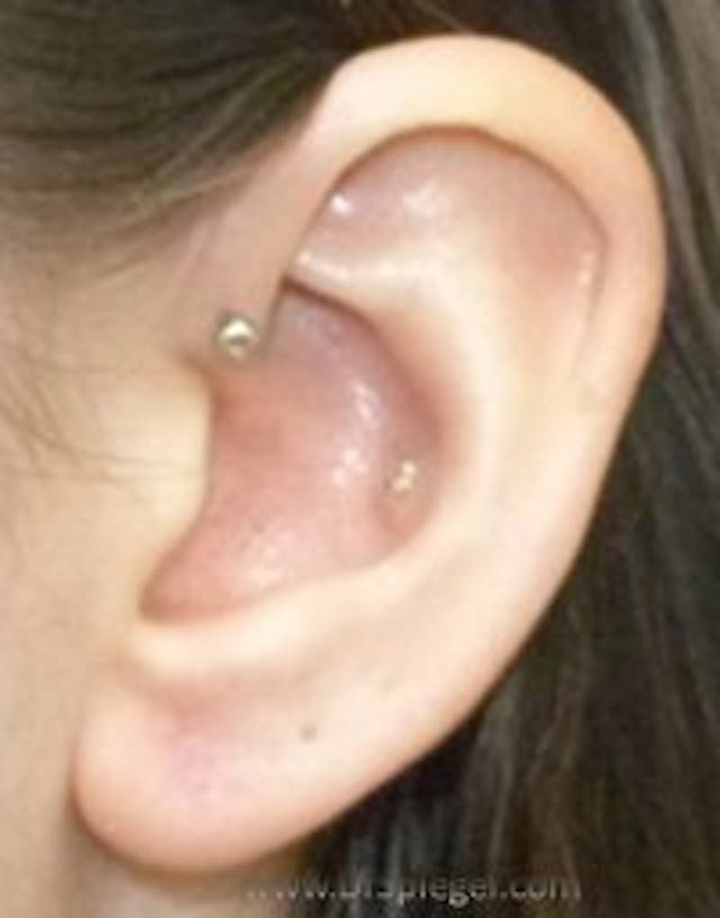 Ear Lobe Repair Before & After Gallery - Patient 336864 - Image 2