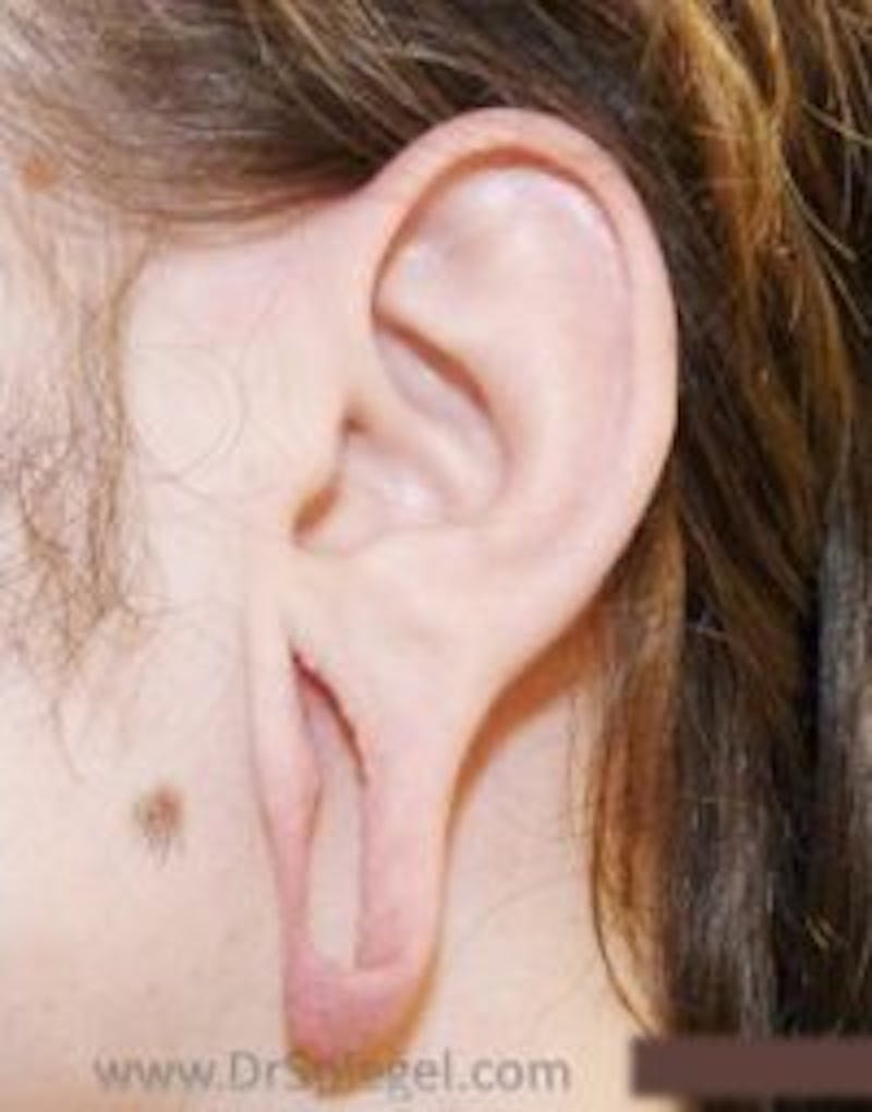 Ear Lobe Repair Before & After Gallery - Patient 921684 - Image 1