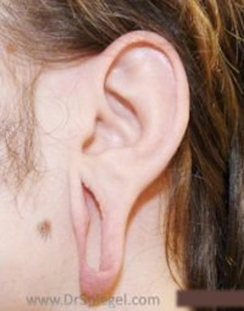 Ear Lobe Repair Before & After Gallery - Patient 921684 - Image 1