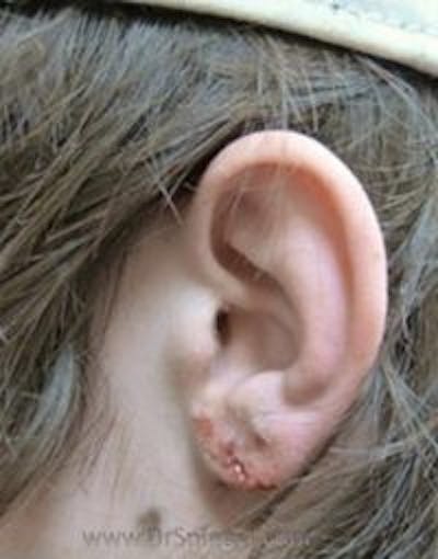 Ear Lobe Repair Before & After Gallery - Patient 921684 - Image 2