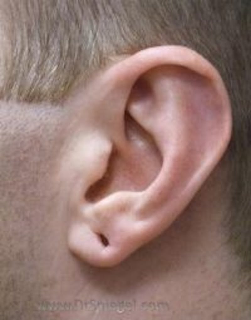 Ear Lobe Repair Before & After Gallery - Patient 750145 - Image 1