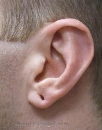 Ear Lobe Repair Before & After Gallery - Patient 750145 - Image 1