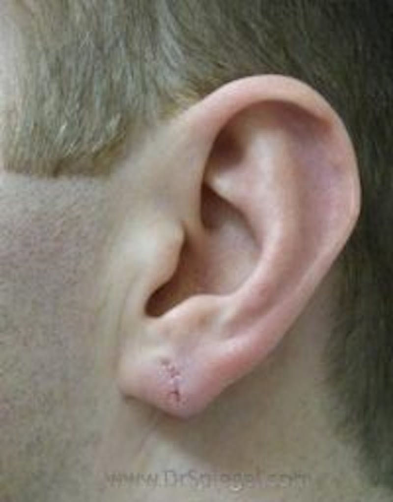 Ear Lobe Repair Before & After Gallery - Patient 750145 - Image 2