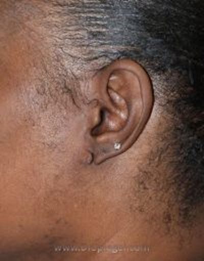 Ear Lobe Repair Before & After Gallery - Patient 259579 - Image 1