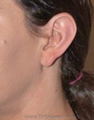Ear Lobe Repair Before & After Gallery - Patient 419044 - Image 1