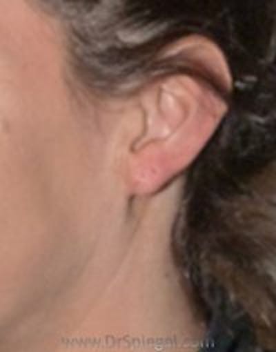 Ear Lobe Repair Before & After Gallery - Patient 419044 - Image 2