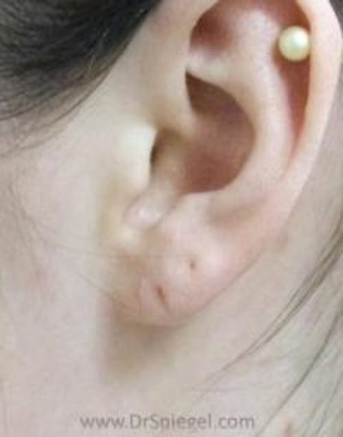 Ear Lobe Repair Before & After Gallery - Patient 602711 - Image 1