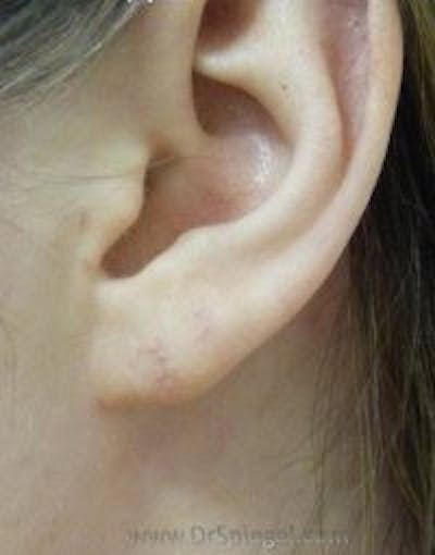 Ear Lobe Repair Before & After Gallery - Patient 602711 - Image 2