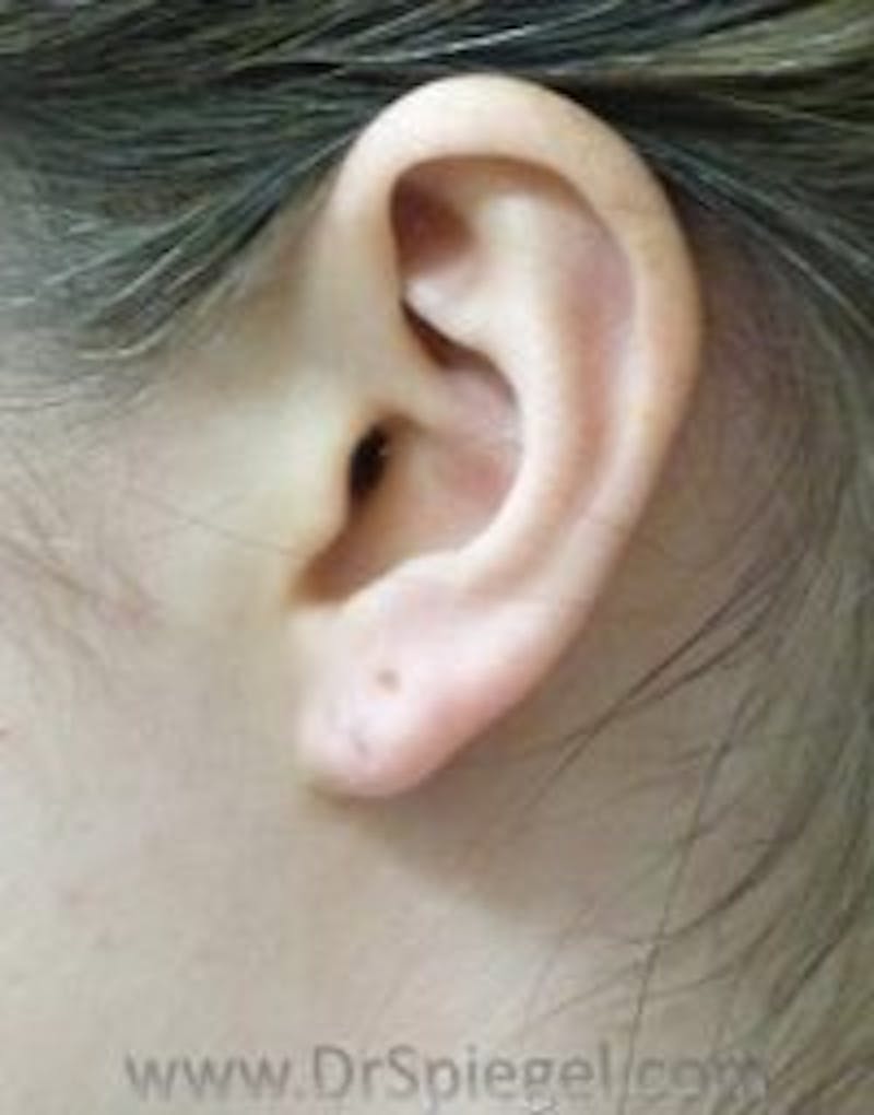 Ear Lobe Repair Before & After Gallery - Patient 182609 - Image 1