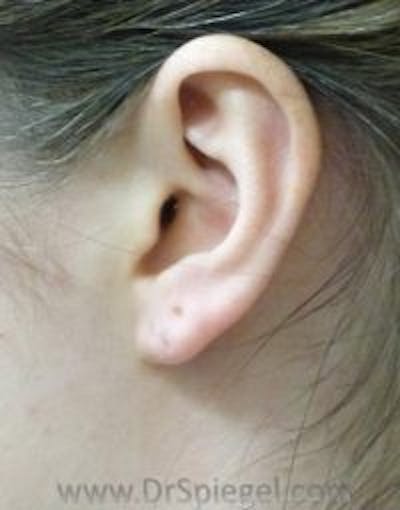 Ear Lobe Repair Before & After Gallery - Patient 182609 - Image 1