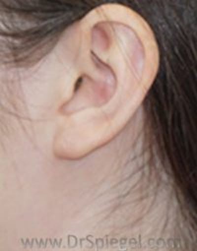 Ear Lobe Repair Before & After Gallery - Patient 182609 - Image 2