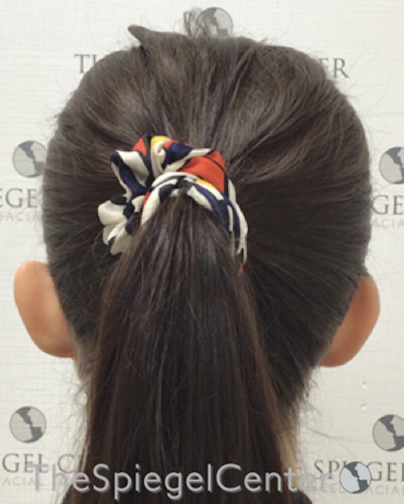 Ear Pinning / Otoplasty Before & After Gallery - Patient 224670 - Image 1