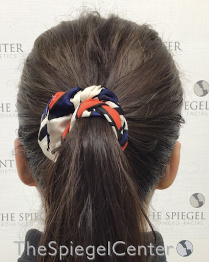 Ear Pinning / Otoplasty Before & After Gallery - Patient 224670 - Image 2