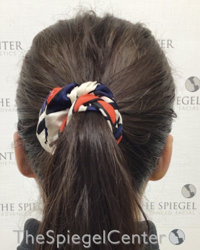 Ear Pinning / Otoplasty Before & After Gallery - Patient 224670 - Image 2