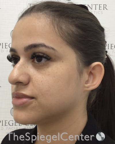 Ear Pinning / Otoplasty Before & After Gallery - Patient 224670 - Image 3