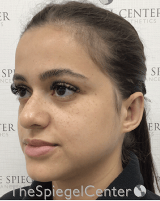 Ear Pinning / Otoplasty Before & After Gallery - Patient 224670 - Image 4