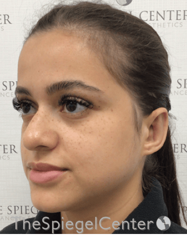 Ear Pinning / Otoplasty Before & After Gallery - Patient 224670 - Image 4