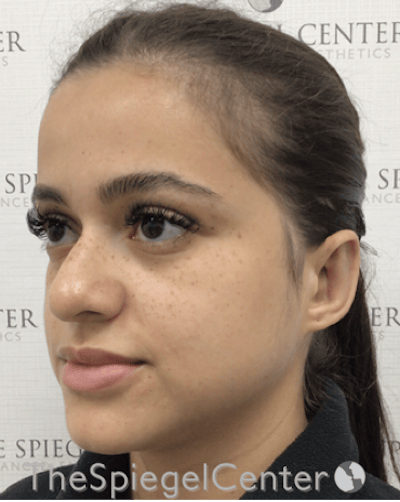 Ear Pinning / Otoplasty Before & After Gallery - Patient 224670 - Image 4