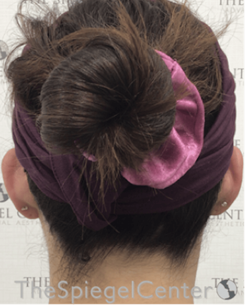 Ear Pinning / Otoplasty Before & After Gallery - Patient 186056 - Image 1