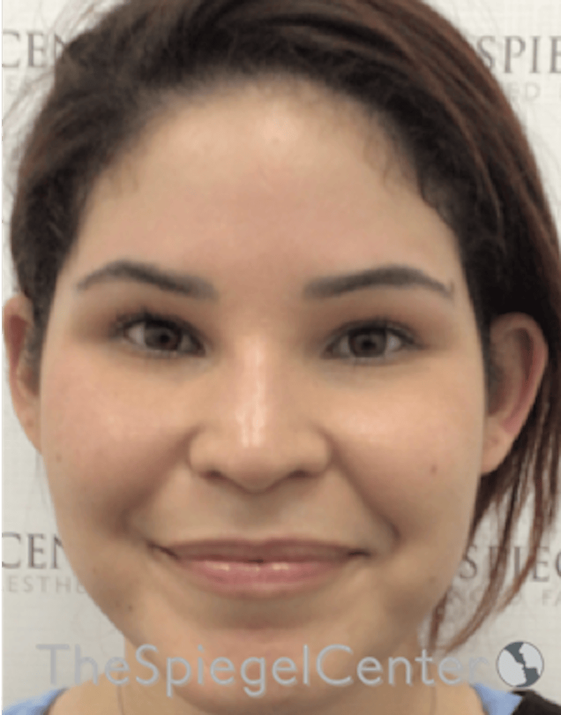 Ear Pinning / Otoplasty Before & After Gallery - Patient 186056 - Image 3