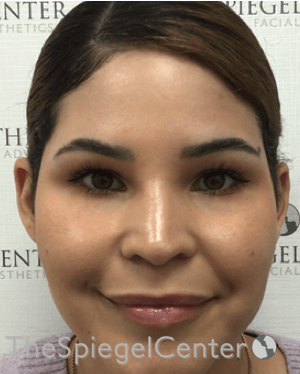Ear Pinning / Otoplasty Before & After Gallery - Patient 186056 - Image 4
