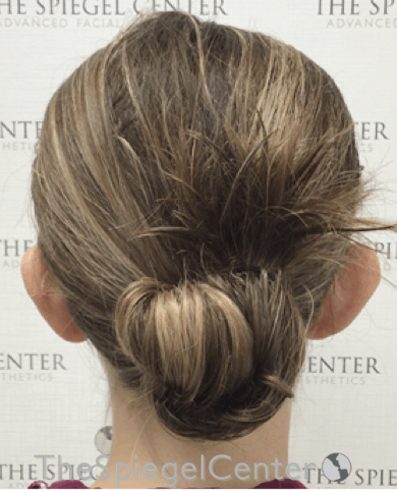Ear Pinning / Otoplasty Before & After Gallery - Patient 172652 - Image 1