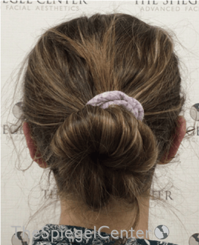 Ear Pinning / Otoplasty Before & After Gallery - Patient 172652 - Image 2