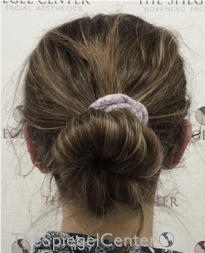 Ear Pinning / Otoplasty Before & After Gallery - Patient 172652 - Image 2