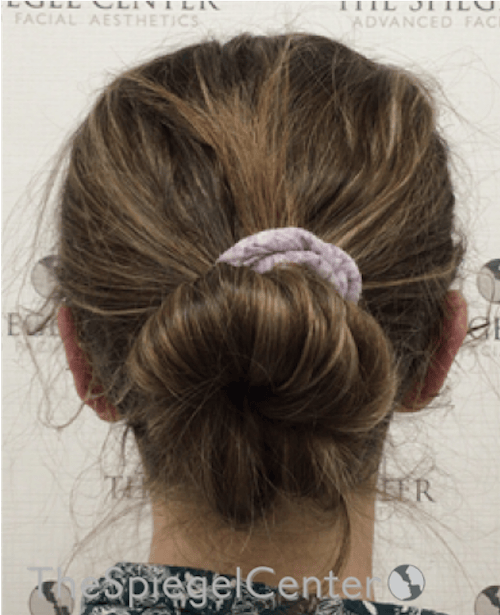 Ear Pinning / Otoplasty Before & After Gallery - Patient 172652 - Image 2