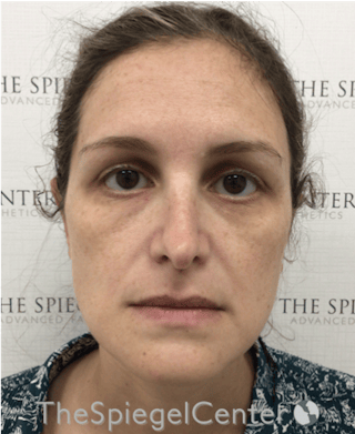 Ear Pinning / Otoplasty Before & After Gallery - Patient 172652 - Image 4