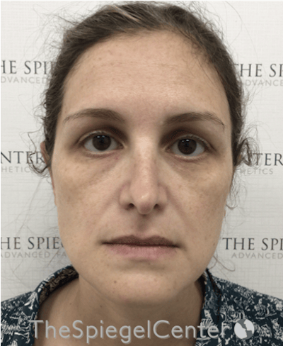 Ear Pinning / Otoplasty Before & After Gallery - Patient 172652 - Image 4