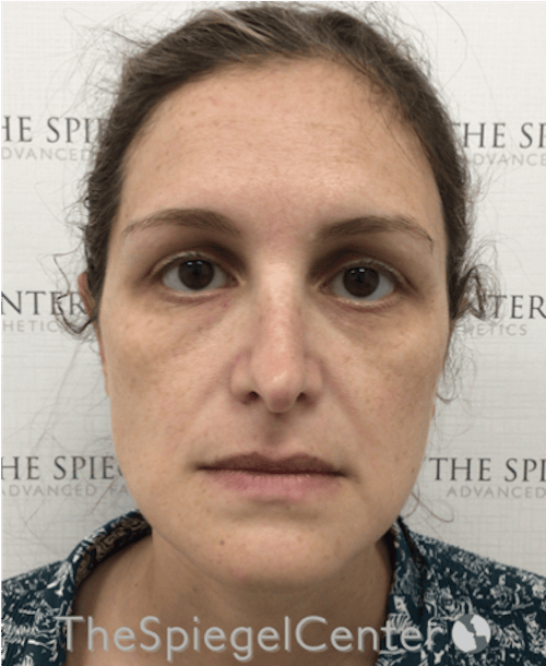Ear Pinning / Otoplasty Before & After Gallery - Patient 172652 - Image 4