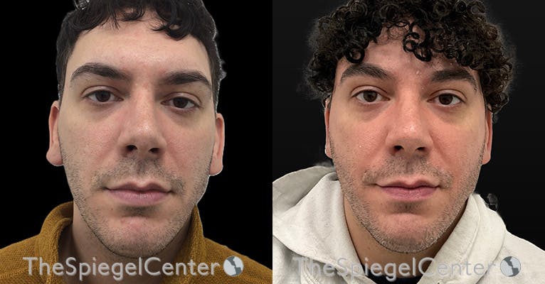 Ear Pinning / Otoplasty Before & After Gallery - Patient 176619 - Image 1