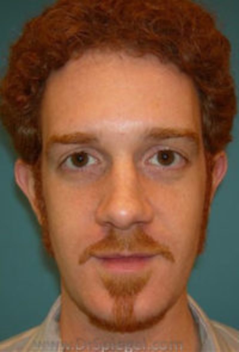 Ear Pinning / Otoplasty Before & After Gallery - Patient 505780 - Image 1