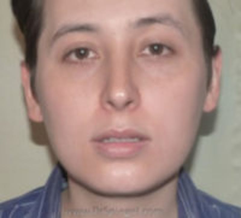 Ear Pinning / Otoplasty Before & After Gallery - Patient 237109 - Image 1