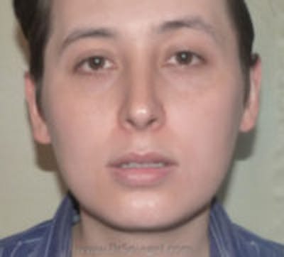 Ear Pinning / Otoplasty Before & After Gallery - Patient 237109 - Image 1