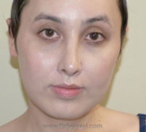 Ear Pinning / Otoplasty Before & After Gallery - Patient 237109 - Image 2