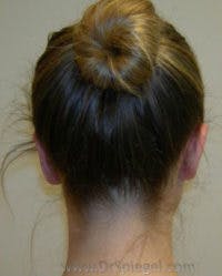 Ear Pinning / Otoplasty Before & After Gallery - Patient 205211 - Image 2