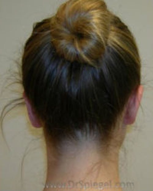 Ear Pinning / Otoplasty Before & After Gallery - Patient 205211 - Image 2