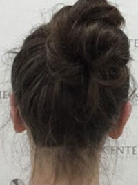 Ear Pinning / Otoplasty Before & After Gallery - Patient 265189 - Image 4