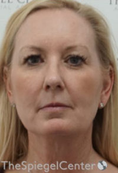 Facelift Before & After Gallery - Patient 649012 - Image 1