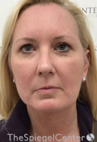 Facelift Before & After Gallery - Patient 649012 - Image 2