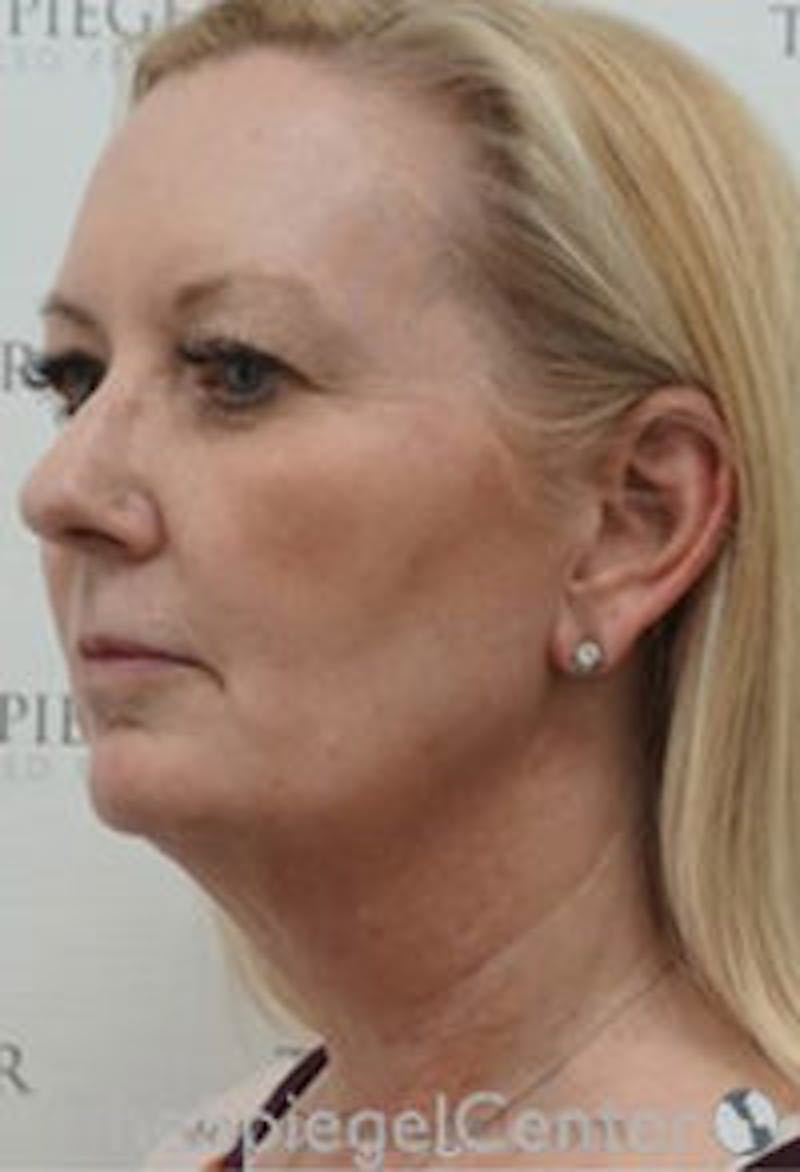 Facelift Before & After Gallery - Patient 649012 - Image 3