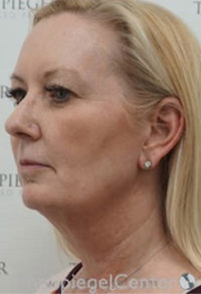 Facelift Before & After Gallery - Patient 649012 - Image 3