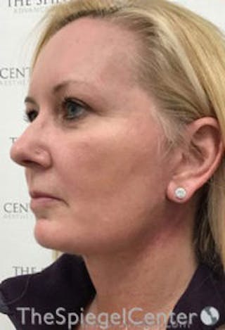 Facelift Before & After Gallery - Patient 649012 - Image 4