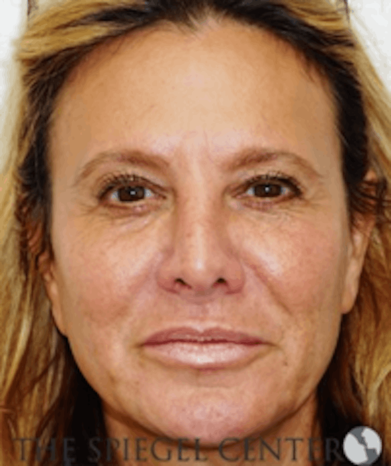 Facelift Before & After Gallery - Patient 368635 - Image 1