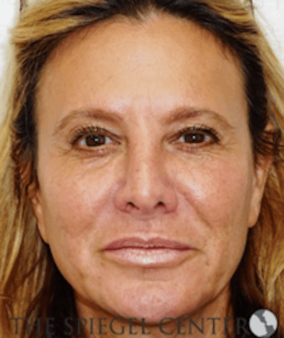 Facelift Before & After Gallery - Patient 368635 - Image 1