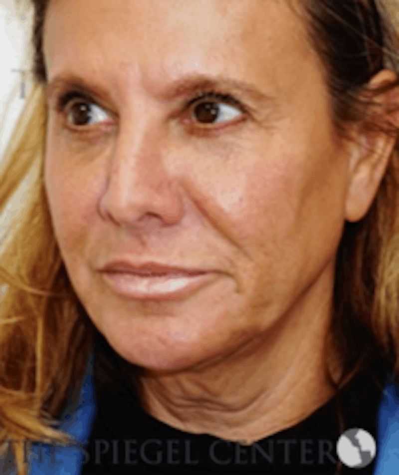 Facelift Before & After Gallery - Patient 368635 - Image 3