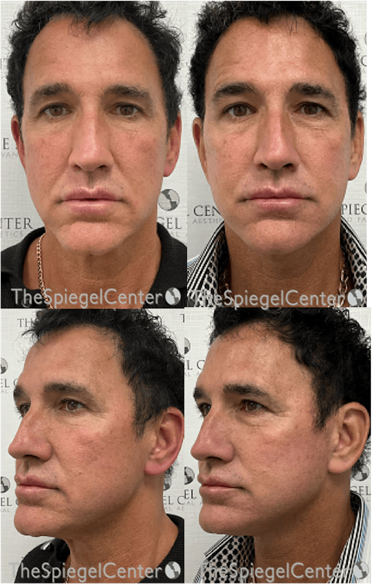 Facelift Before & After Gallery - Patient 236681 - Image 1
